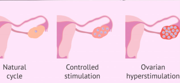 Ovarian Hyperstimulation Syndrome