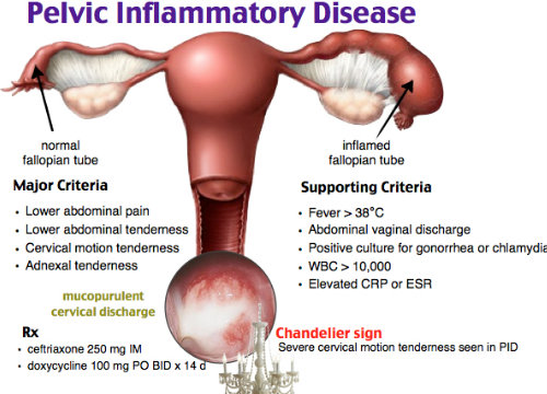 Pelvic Inflammatory Disease