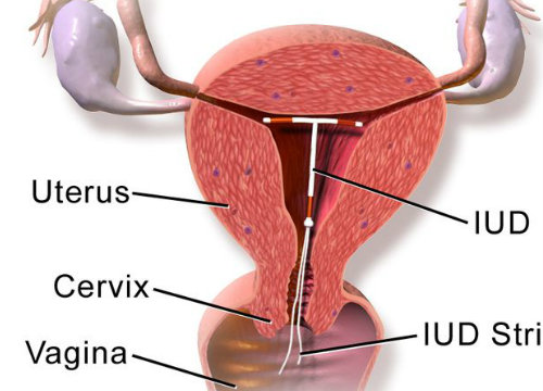 how does IUD work