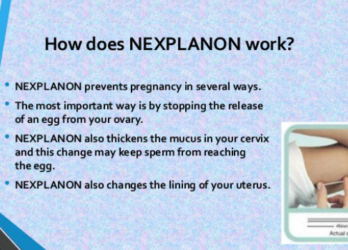 how does nexplanon work