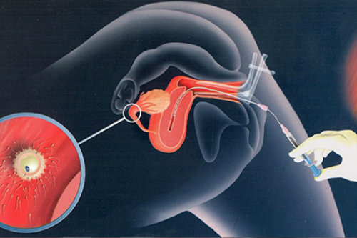 intrauterine_insemination