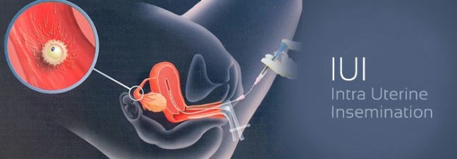 intrauterine insemination