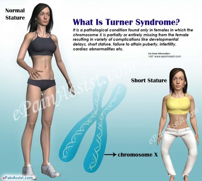 Turner Syndrome