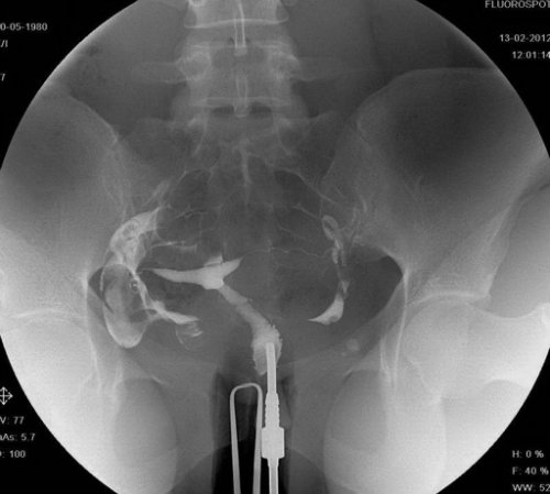 Hysterosalpingogram xray result