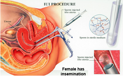 Intrauterine Insemination (IUI)