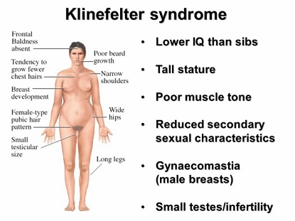 Klinefelter's syndrome