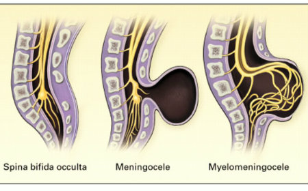 Spina bifida