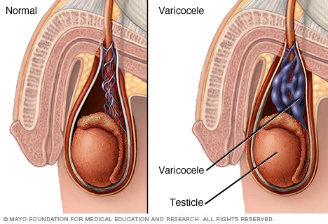 Varicocele veins