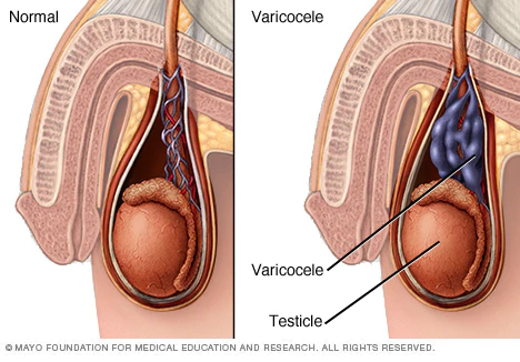 Varicocele veins