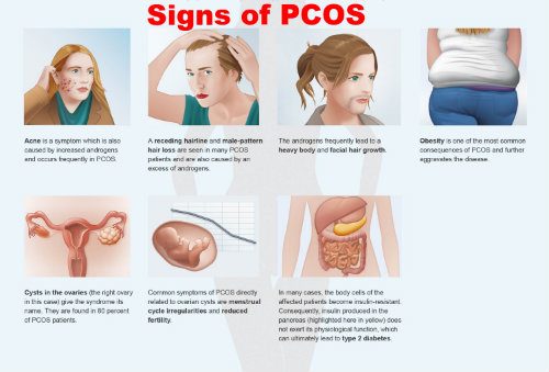 PCOS signs and symptoms