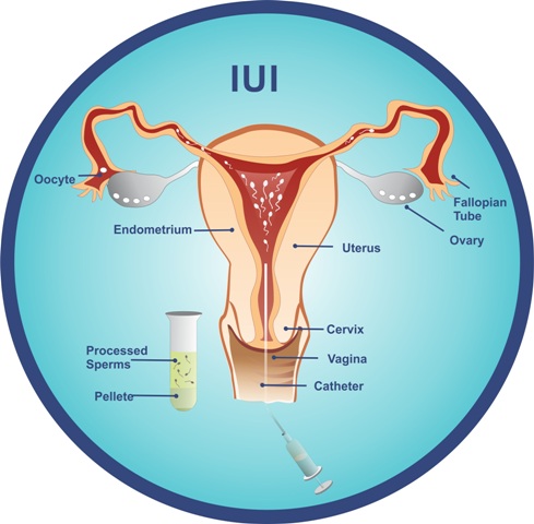 intrauterine insemination IUI