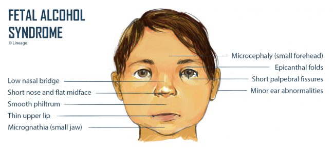 fetal alcohol syndrome - Pregnancy rule