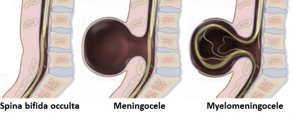 Spinal bifida