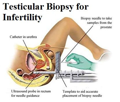 testicular biopsy