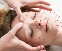 can-acupuncture-boost-your-fertility